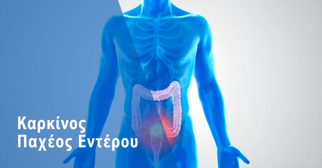 Καρκίνος Παχέος Εντέρου