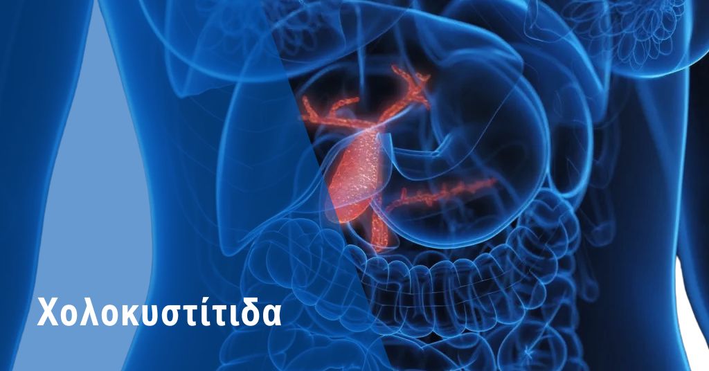 Χολοκυστίτιδα