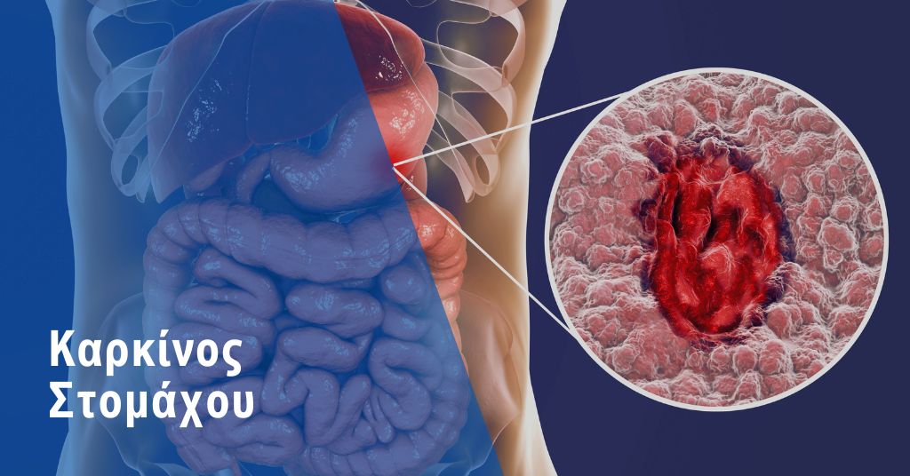 καρκίνος στομάχου
